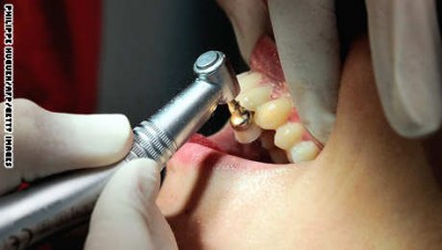 A dentist (L) uses a drill as she treats a patient on September 6, 2013, in Bailleul, northern France.  AFP PHOTO / PHILIPPE HUGUEN        (Photo credit should read PHILIPPE HUGUEN/AFP/Getty Images)