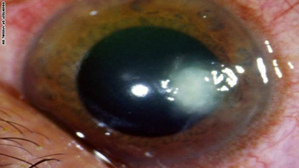 150520132320-funal-eye-ulcer-exlarge-169