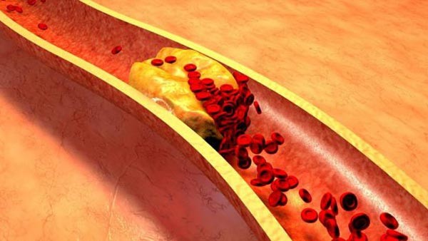 ويحات الكوليسترول في الدم