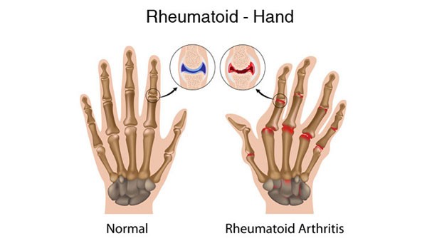 التهاب مفاصل اصابع اليد