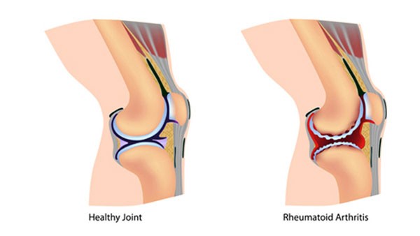 التهاب مفصل الركبة