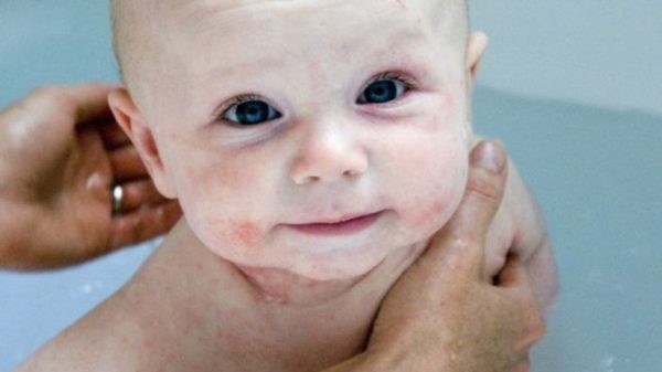 160629120705_eczema_children_640x360_spl_nocredit