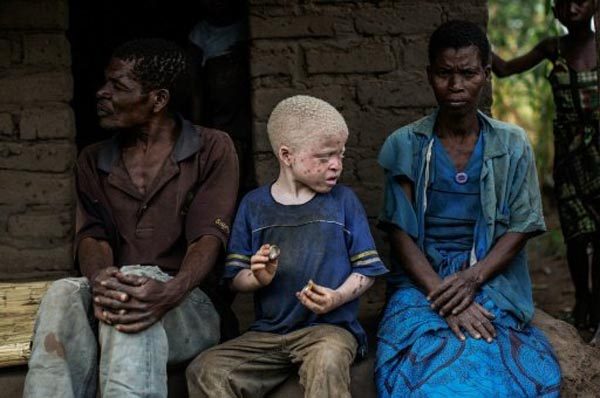 © اف ب/ارشيف | صورة تعود الى 15 نيسان/ابريل 2015 لطفل مصاب بالمهق بين والديه في قريتهم في منطقة ماشينغا بملاوي 