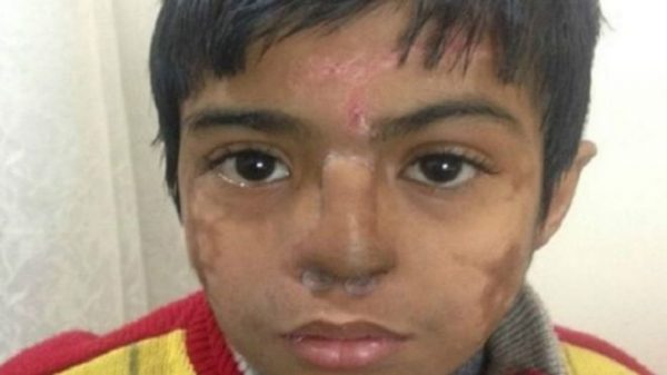 160705153336_indian_doctors_grow_new_nose_on_boys_forehead_640x360_sniazi_nocredit