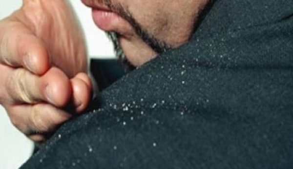 الإسبرين لعلاج القشرة التخلص من القشرة