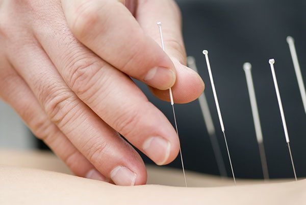 Doctor uses needles for treatment of the patient