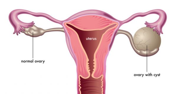 ovarian-cyst