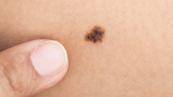 151019085715_mole_640x360_thinkstock_nocredit